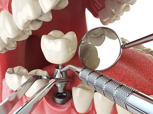 Best Emergency Wisdom Tooth Extraction in Sewanee, TN
